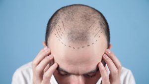 hair loss treatment