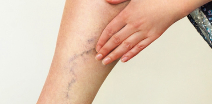 best treatment for Venous insufficiency treatment