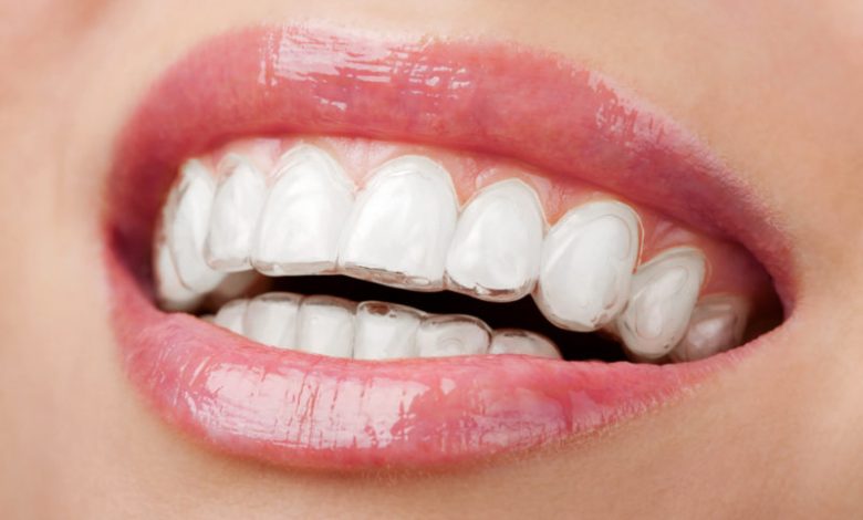 invisalign aligners