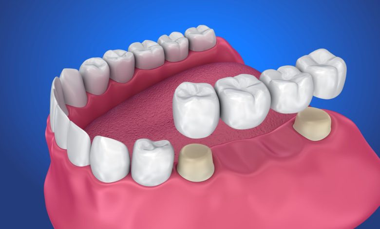 dental crown and bridges