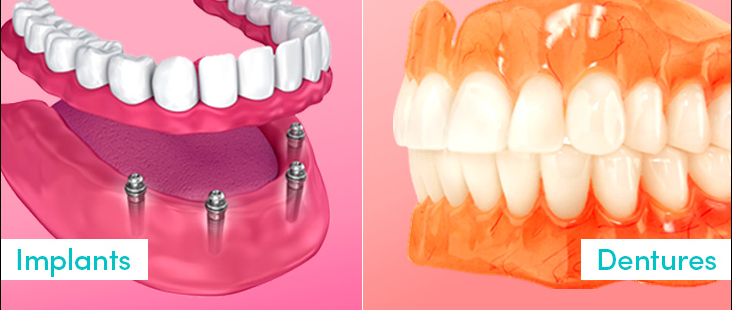 dentures and implants