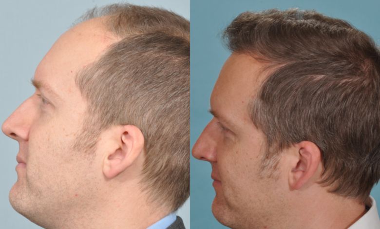 Hair Transplant Cost in Delhi