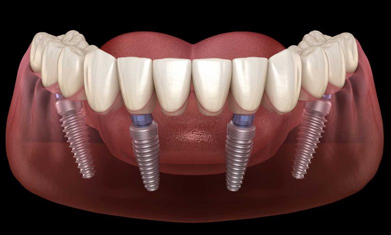 dental implants denture