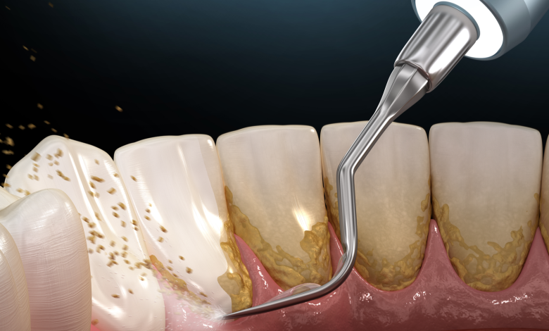 periodontal scaling and root planing