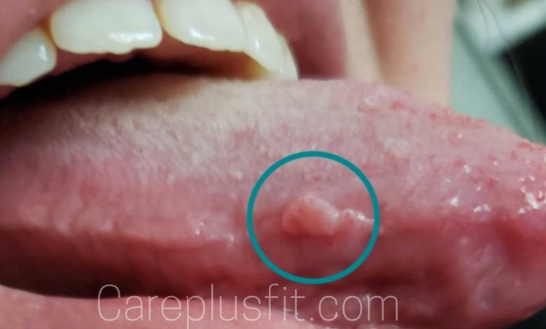 pimple on tongue