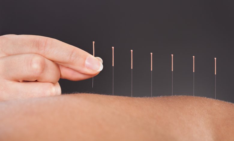 What Are Some Highly Rated Acupuncture In the UK?