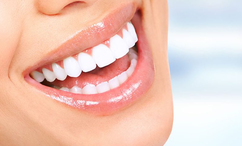 Teeth Whitening in Dubai